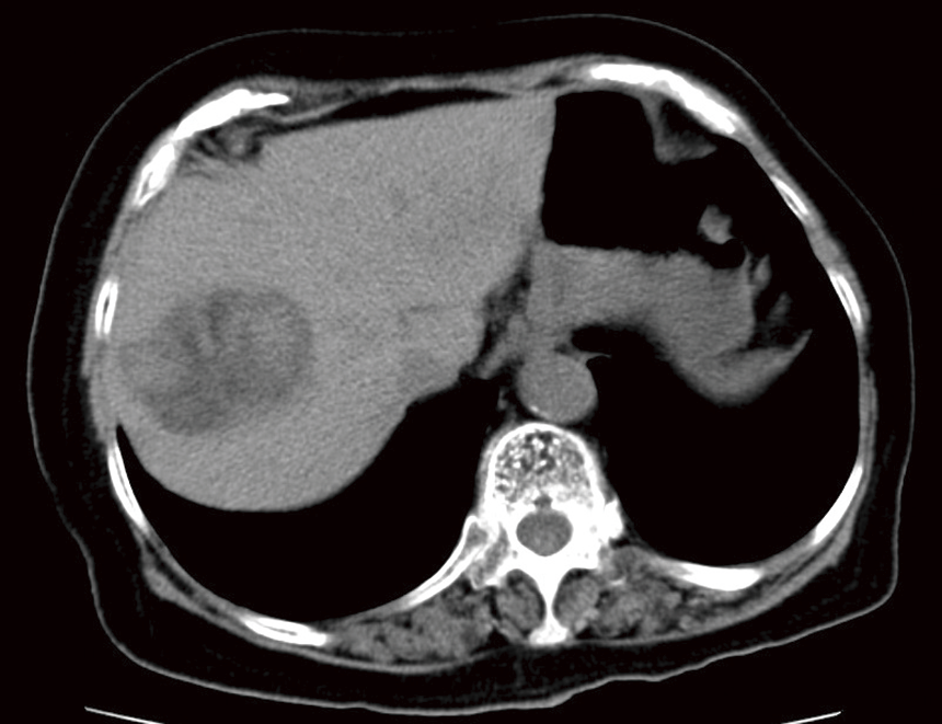 エコーで偶然見つかった肝臓がん（CT）