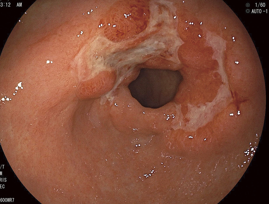 前庭部進行胃がん（60歳代女性）ピロリ菌＋