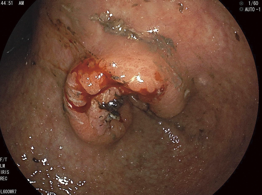 前庭部進行胃がん狭窄＋（60歳代男性）ピロリ菌＋