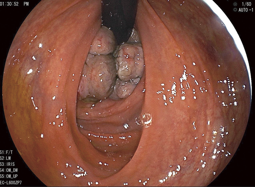 大腸ファイバー直腸反転で内側から見た内痔核