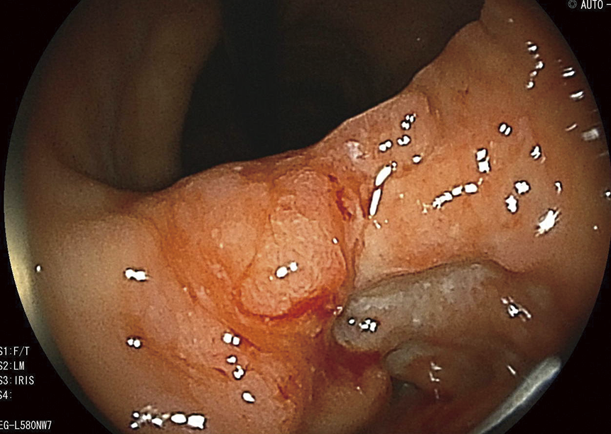 胃角幽門側進行胃がん  境目が不整（50歳代女性）ピロリ菌＋